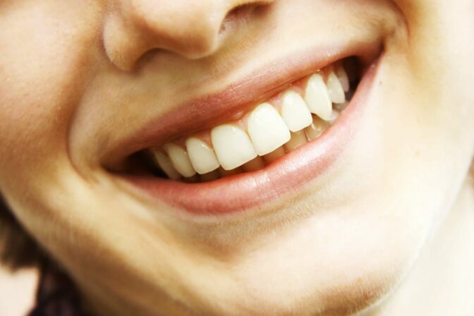 W jaki sposób wykonuje się bonding?